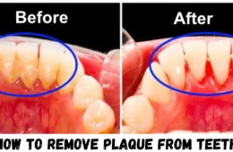 HOW TO REMOVE PLAQUE FROM TEETH