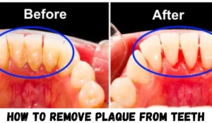 HOW TO REMOVE PLAQUE FROM TEETH