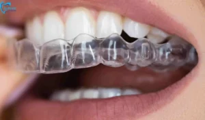 Invisible Braces for Adults