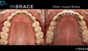 Lingual Braces for Adults
