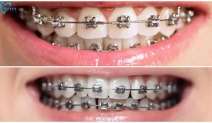 Metal Braces for Adults