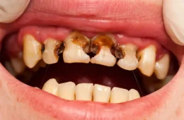 Rotten Teeth: Causes, Symptoms, Stages, Treatment & Can It Make You Sick?