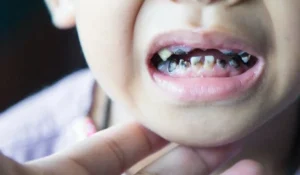 Rotten Teeth in Children