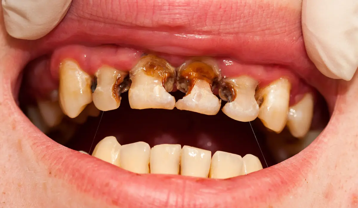 Rotten Teeth