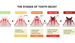 Stages of Rotten Teeth
