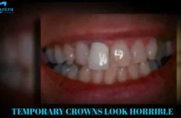 TEMPORARY CROWNS LOOK HORRIBLE