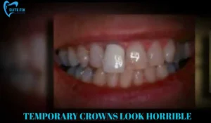 TEMPORARY CROWNS LOOK HORRIBLE