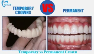 Temporary vs Permanent Crown