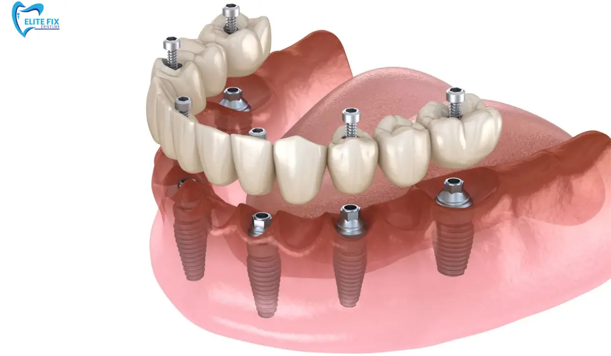 Types of Dental Implants