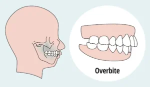 What Causes Buck Teeth