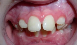 What Do Buck Teeth Look Like