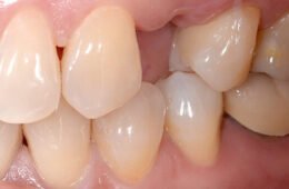 What Happens If You Don’t Replace a Missing Tooth? (Hint: It Gets Worse)